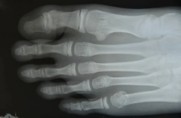 Kości stopy z bliska — Zdjęcie stockowe