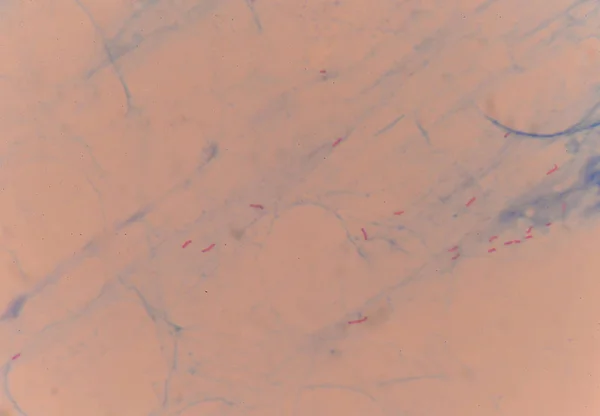 Красные клетки кислоты быстрые бациллы — стоковое фото