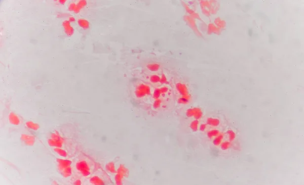 适度的红色白血细胞与革兰阴性双球菌. — 图库照片