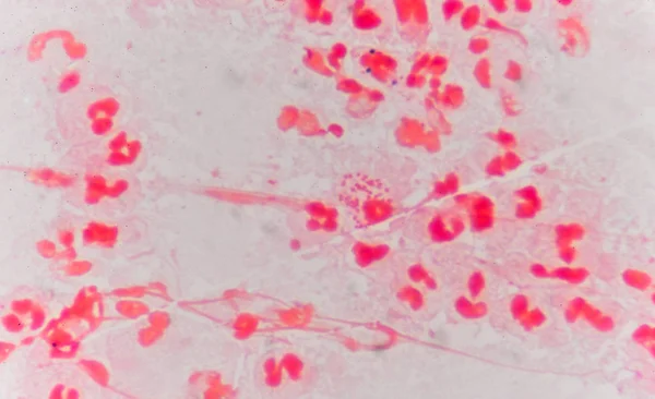 Globules blancs rouges modérés avec des diplocoques Gram négatif . — Photo