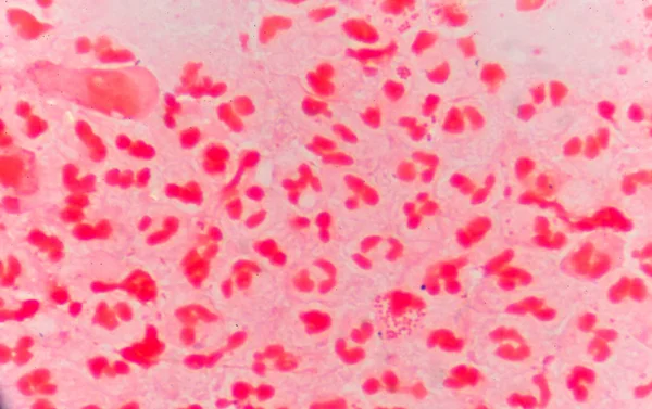 Globules blancs rouges modérés avec des diplocoques Gram négatif . — Photo