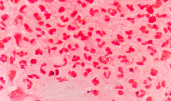 Glóbulos blancos rojos moderados con diplococos gramnegativos . — Foto de Stock