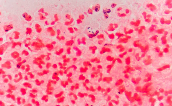 Globules blancs rouges modérés avec des diplocoques Gram négatif . — Photo