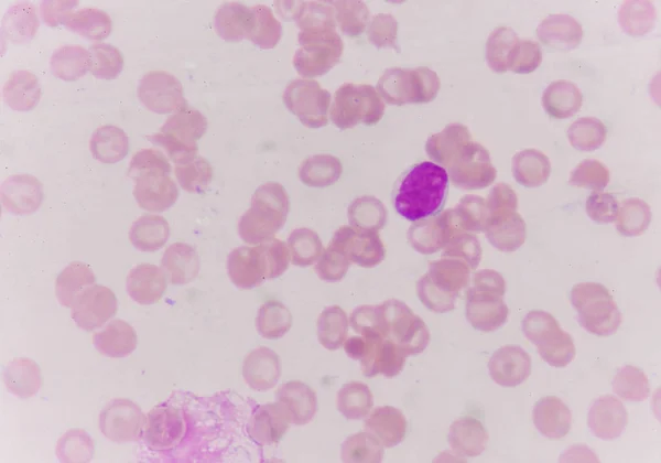 Blast buňky v krevním nátěru. — Stock fotografie