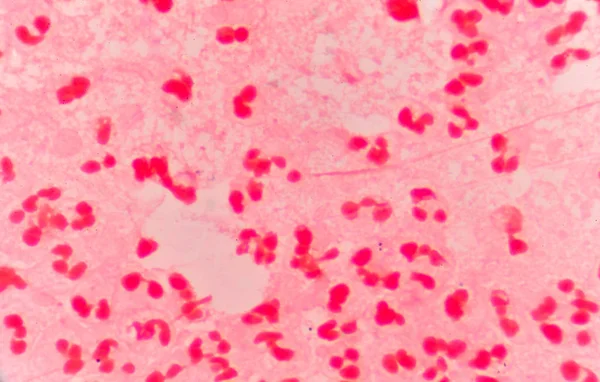 Glóbulos blancos rojos moderados con diplococos gramnegativos . — Foto de Stock