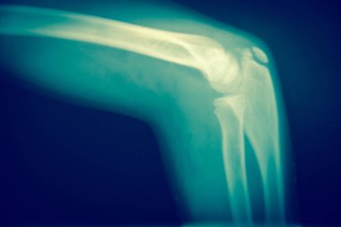 Kemik x-ışını kapatmak 