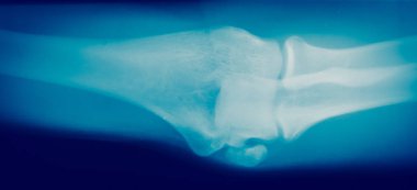 Kemik x-ışını kapatmak 