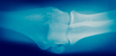 Kemik x-ışını kapatmak 