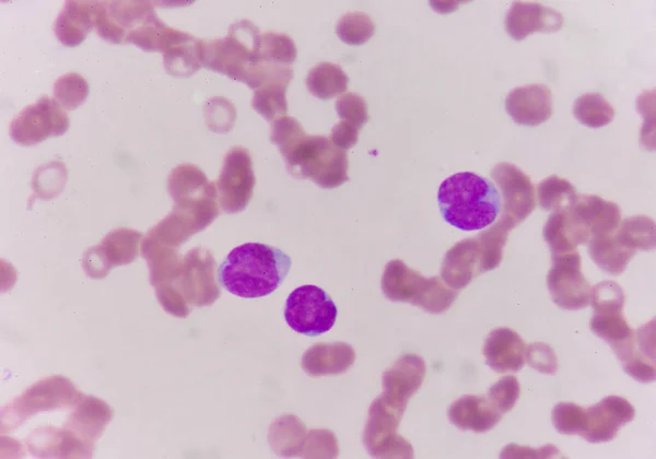 Взрывные клетки в мазке крови . — стоковое фото
