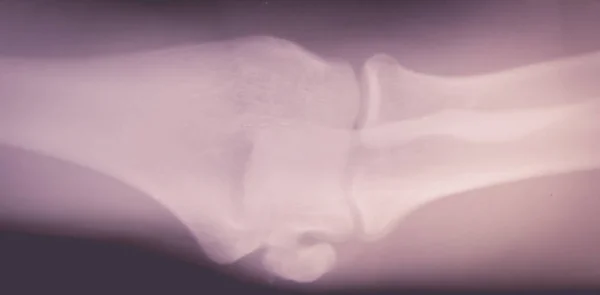 Close up  bone  x-ray — Stock Photo, Image