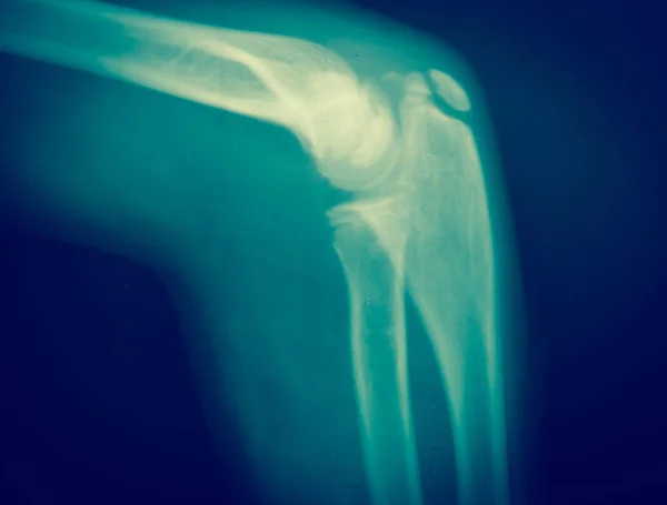 Крупним планом рентген кістки — стокове фото