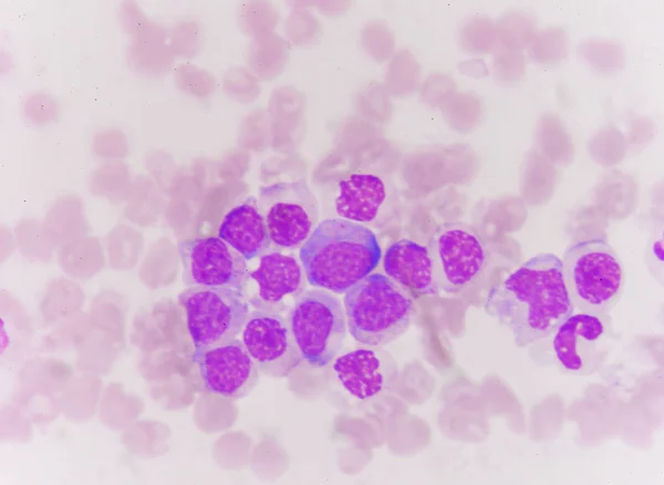 Cellule blastiche in leucemia — Foto Stock