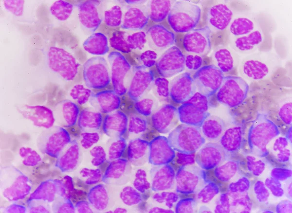 Blast cellen in leukemie — Stockfoto