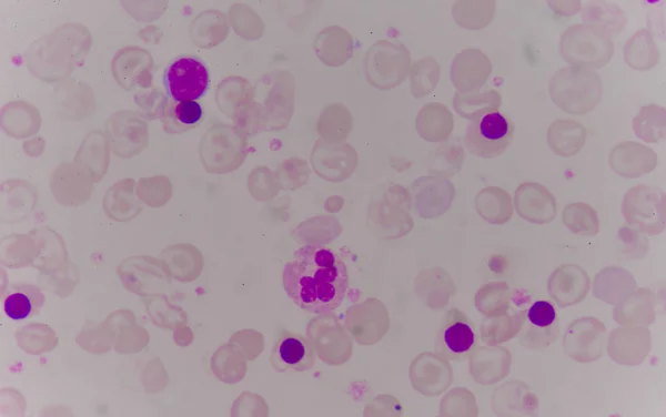 Blood smear anemia patient — Stock Photo, Image