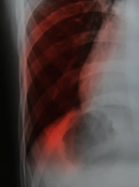 Крупним планом рентген грудей — стокове фото