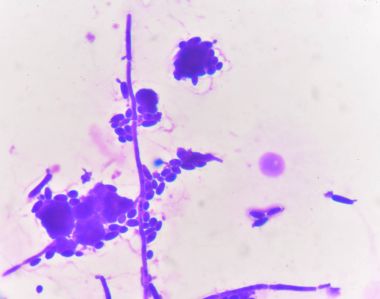 Tomurcuklanma Maya hücreleri pseudohyphae Gram leke yöntemi ile