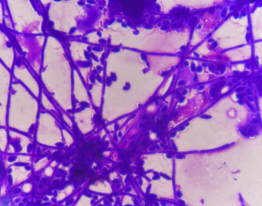 Tomurcuklanma Maya hücreleri pseudohyphae Gram leke yöntemi ile