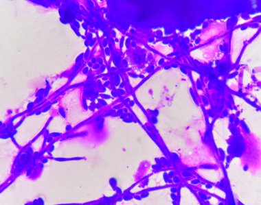 Tomurcuklanma Maya hücreleri pseudohyphae Gram leke yöntemi ile