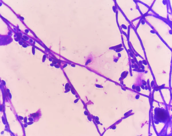 Cellules de levure bourgeonnantes avec méthode de coloration Gram pseudohyphes — Photo