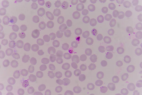 Blood films for Malaria parasite.show malaria pigment. — Stock Photo, Image