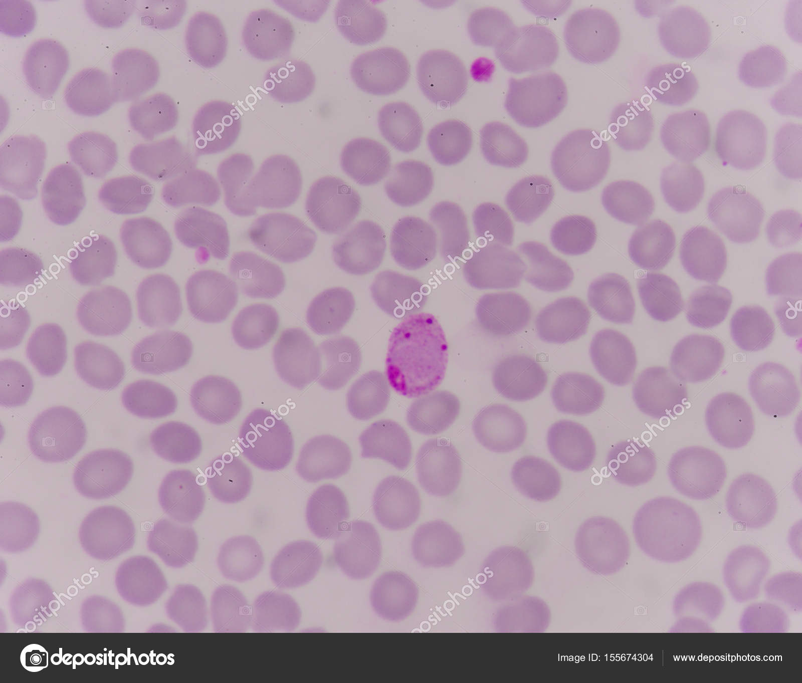 Malaria Parasite In Blood Stock Photo Image By C Toeytoey 155674304