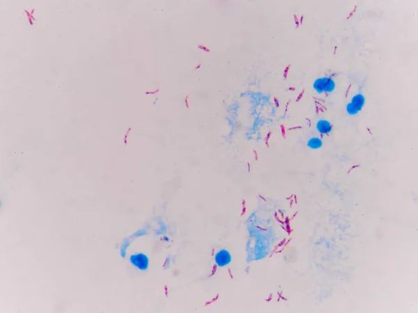 Mycrobacterium tuberculosis eritrocitos . — Foto de Stock