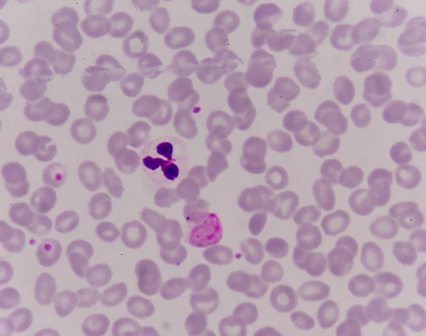 Malaria parasite in blood. — Stock Photo, Image