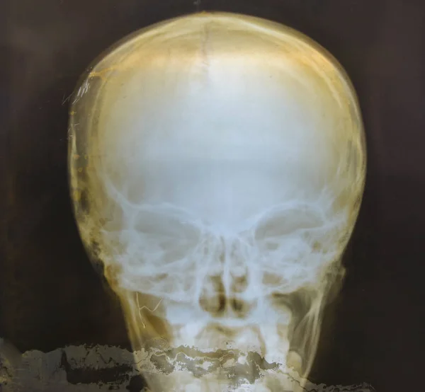Rayos X del cráneo del concepto médico humano . — Foto de Stock