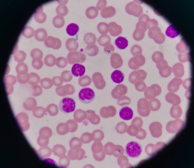 CLL blood smear clipart
