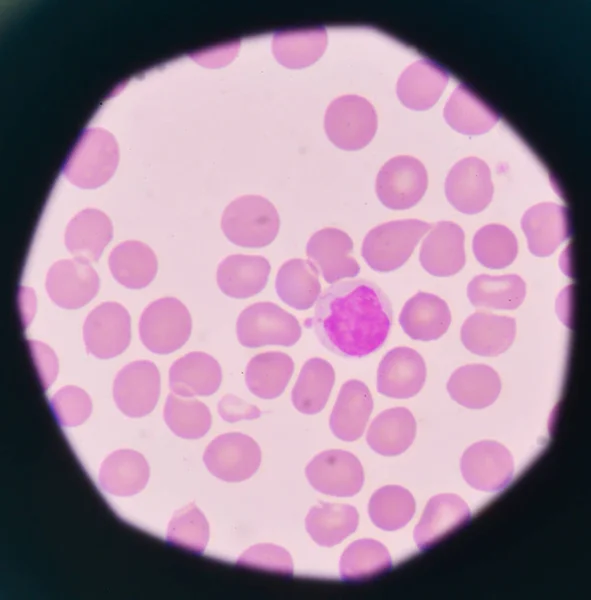 Білі кров'яні тільця на фоні еритроцитів . — стокове фото