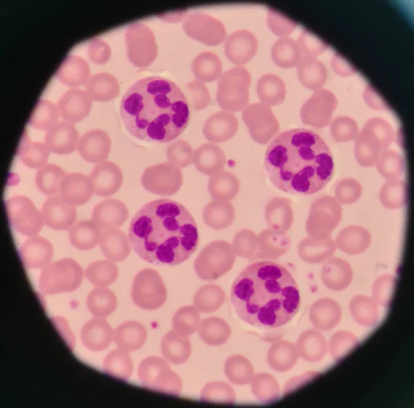 Glóbulos brancos no fundo dos glóbulos vermelhos . — Fotografia de Stock