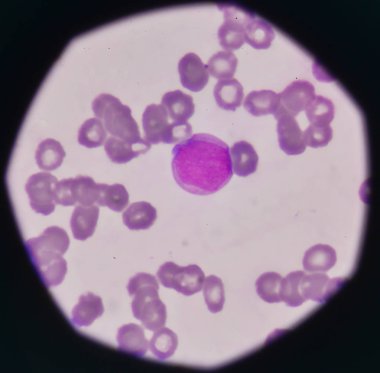 Blast hücre üzerinde kan yayması.