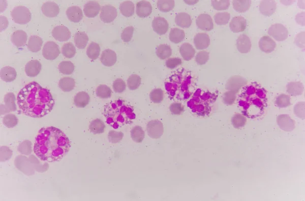 Neutrophil sejtek a bilirubin — Stock Fotó