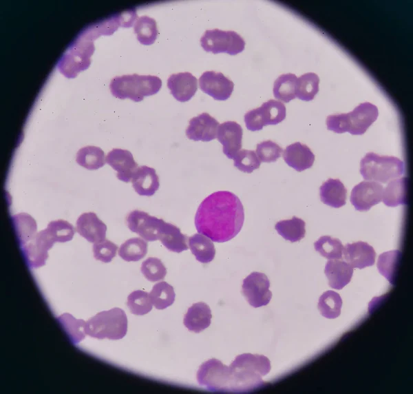 Blastocitos en frotis de sangre . — Foto de Stock