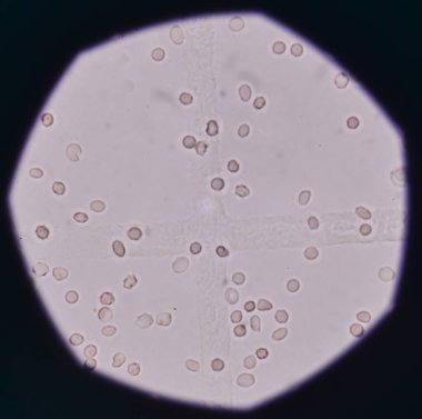 Taze kırmızı kan hücreleri idrar örneği.