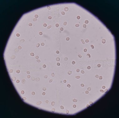 Taze kırmızı kan hücreleri idrar örneği.