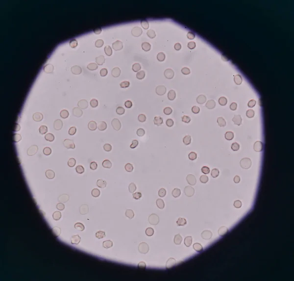 Fresh red blood cells in urine sample. — Stock Photo, Image