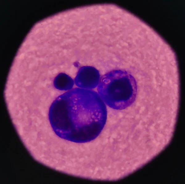 Fluido pleurico del campione di cellule maligne anormali . — Foto Stock