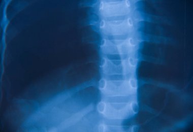 Göğüs röntgeni