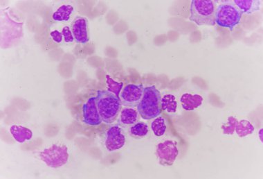 anormal hücreler gösterilen. Tıp biliminin arka plan kavramı.