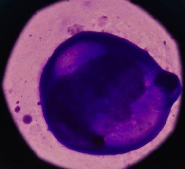 Malign plevral sıvı hücrelerde.