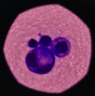 Malign plevral sıvı hücrelerde.