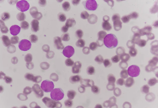 Cellule blastiche in leucemia — Foto Stock