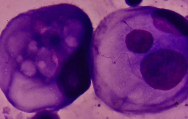 Sejtek malignus pleurális folyadék. — Stock Fotó