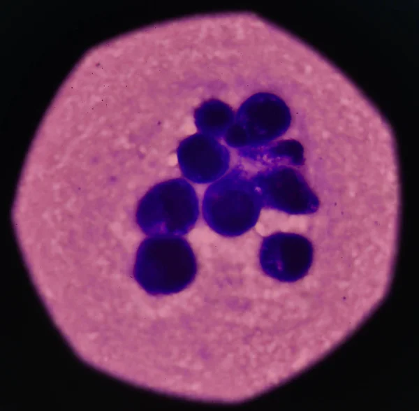 Злокачественные клетки плевральной жидкости . — стоковое фото