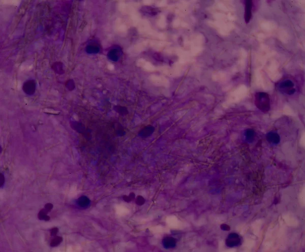白血细胞与尿酸晶体针形状 — 图库照片