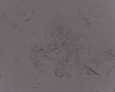 Orta Ürik asit kristal iğne şekli