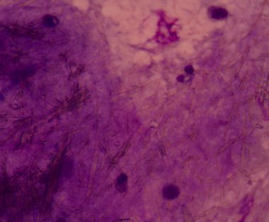 beyaz kan hücreleri Ürik asit kristal iğne şeklinde