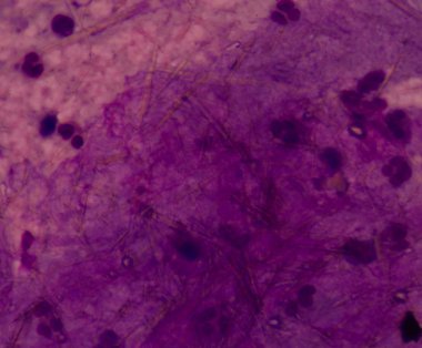 beyaz kan hücreleri Ürik asit kristal iğne şeklinde