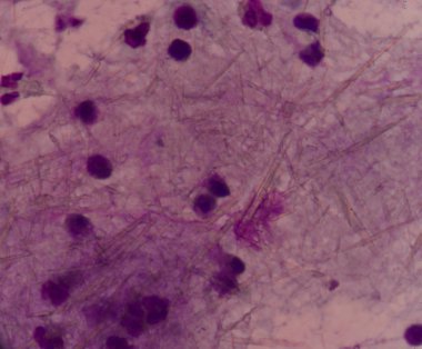 beyaz kan hücreleri Ürik asit kristal iğne şeklinde